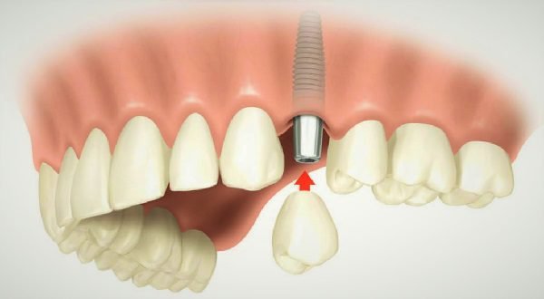 Имплантация зубов как современное лечение и протезирование. 