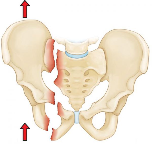 Перелом лонной кости таза - симптомы и лечение. 