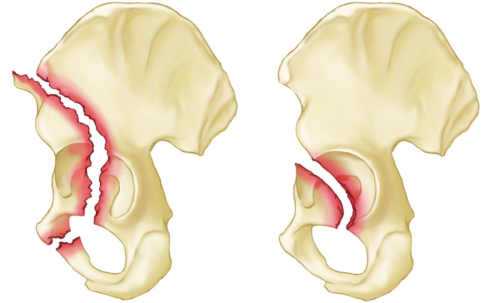 Перелом лонной и седалищной кости