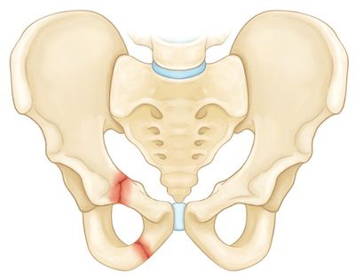 Перелом лонной кости таза - симптомы и лечение. 
