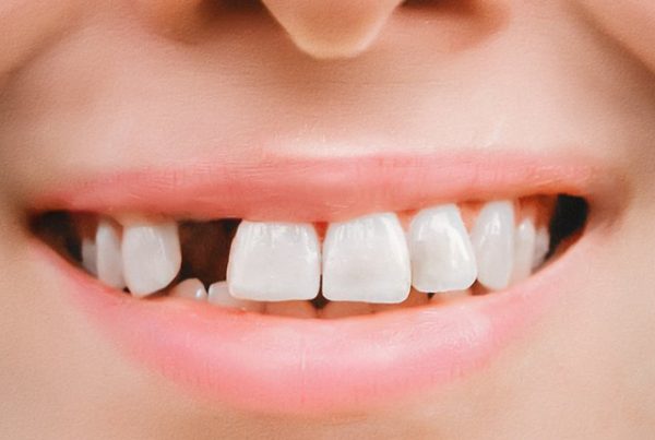 Адентия зубов – причины и лечение. 