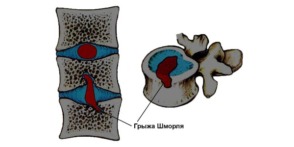 Грыжа Шморля. 